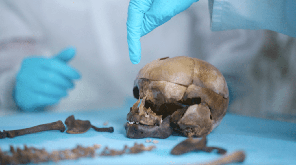 analyse d'un crâne d'enfant dans le cadre d'une affaire criminelle et sciences forensiques - IRCGN