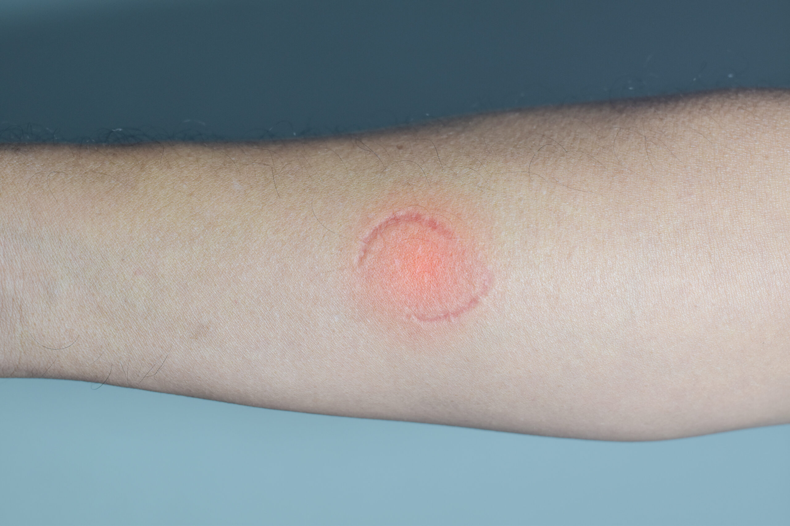 bite marks on victim - morsure